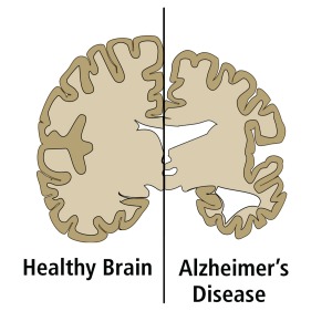 ELISA에 의한 알츠하이머병 연구